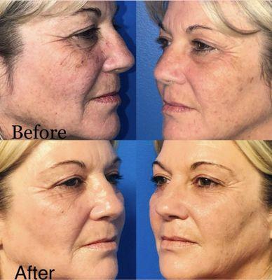 Chemical Peel before and after