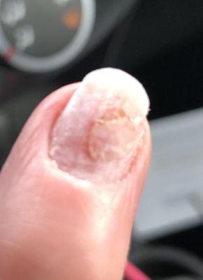 My finger after trying to pry my acrylic nail off.