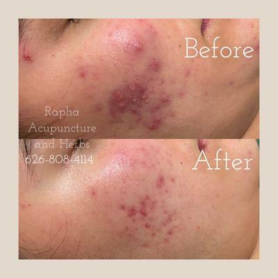 Acne treatment before and after.