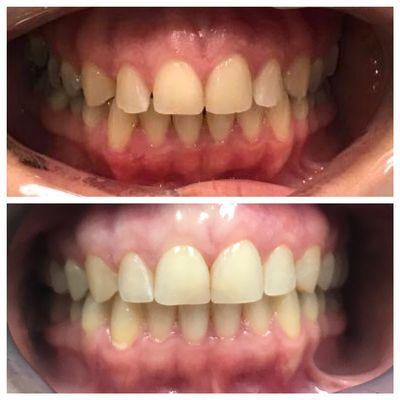 Before and after Invisalign treatment