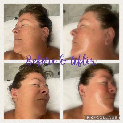 Dermaplane facial