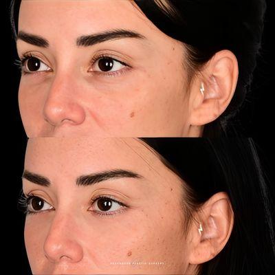 Before and After | Under-eye Dark Circle Correction