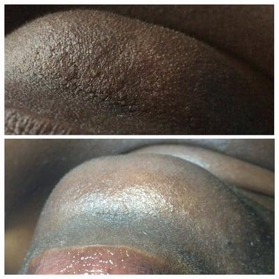 Top: Chin is clogged with whiteheads. Bottom: Impurities are removed and pores are minimized