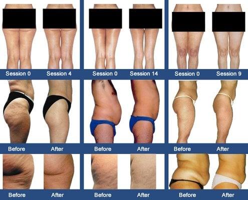 LPG-Endermologie (Before & After)-FDA approved, non-invasive solution to cellulite and body conditioning originated from France.