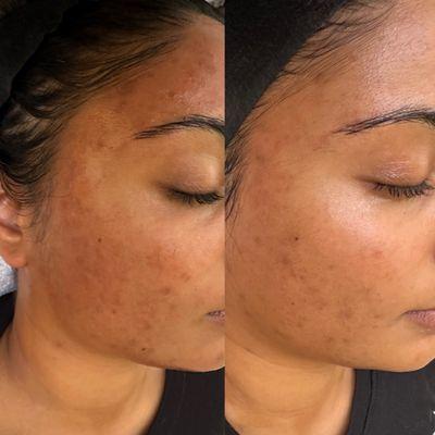 Before and after acne book camp client