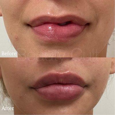 Lip Filler