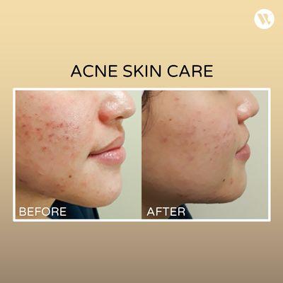 Before and After Acne Skin Care at Luz Wave Spa & Aesthetics.