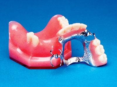 Partial Denture with Metal Framework