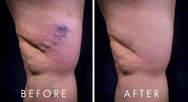 Vein treatment / removal patient before and after results. Contact us to learn more.