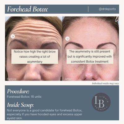 Forehead wrinkle relaxer (Botox, Dysport, Daxxify) by Dr. DePorto at Liquid Beauty Temecula.