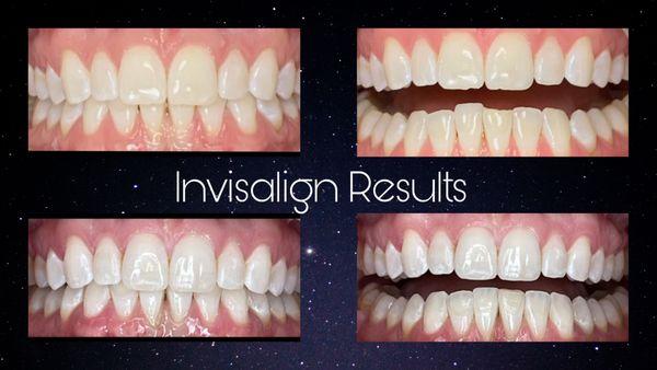 #invisaligndentist #beforeandafter