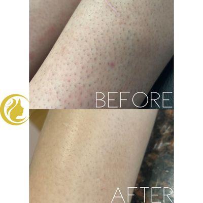 Laser Hair Removal before and after