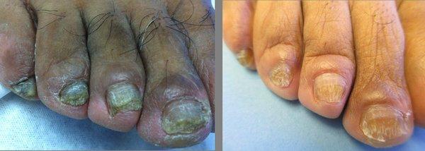 Laser Fungus Before & After 3 treatments.