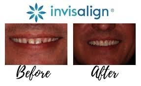 Invisalign