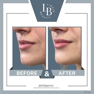 Restylane Kysse 1/2 syringe lip filler augmentation with Botox lip flip at Liquid Beauty Temecula by Dr. DePorto MD.