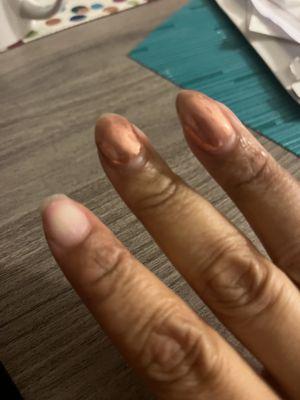 A week and a half later, nail comes completely off!