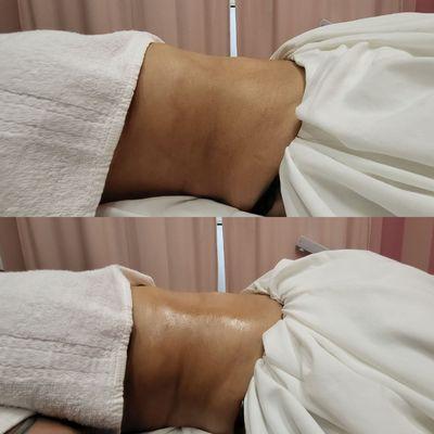 Lymphatic Drainage Massage