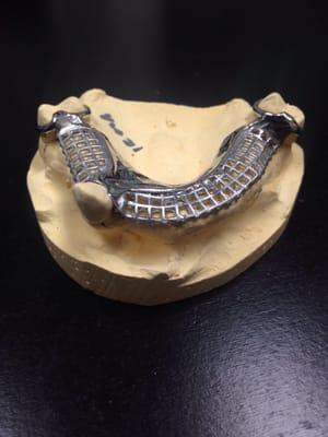 These guys made a metal frame work for an upper partial denture.