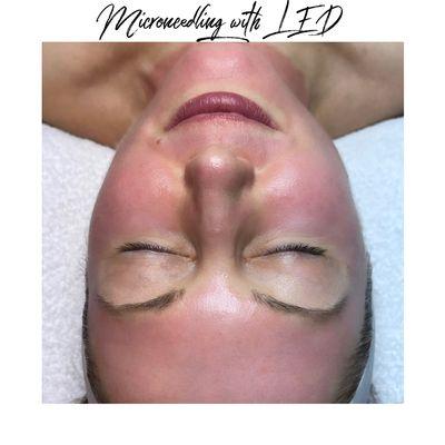 Post micro needling with LED therapy