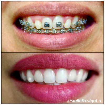 After Braces, Patient received Gingiva contouring and veneers to fix her smile!