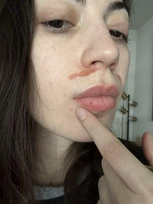 Pointing to scab to show where wax was also unnecessarily applied down towards my chin under my lower lip..