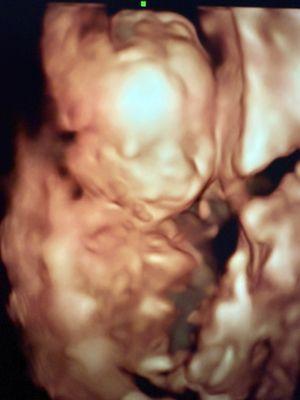 4D ultrasound