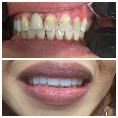 Cosmetic Makeover! Front 6 Porcelain Crowns. Looks Beautiful!