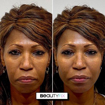 "Liquid Lift" with a custom BeautyQuickFix that includes CheekFix, ChinFix, WrinkleFix and EyeFix