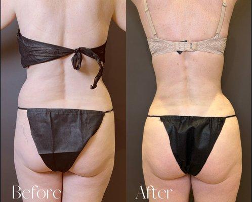 Female 3 Months After 360 Liposuction