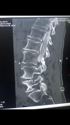 Lumbar spine X-Ray showing narrowing of spinal canal