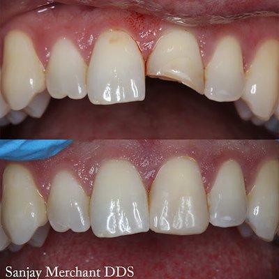 Non-invasive cosmetic bonding to repair a fractured tooth. This repair was done in 30 minutes.