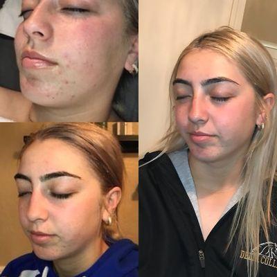 Aloe Algae facial. Two week progress photos. This facial targets acne, rosacea and sensitive skin. Includes high frequency and jade rolling