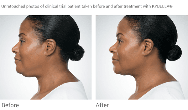 Kybella permanently dissolves fat with a quick non-invasive procedure. http://www.wellmedicalarts.com/kybella/