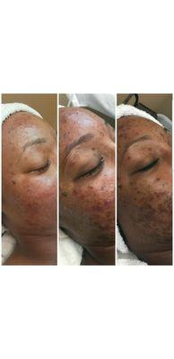 CORRECTIVE SKIN CARE ACNE FACIALS ! Consistency is KEY 3 months !