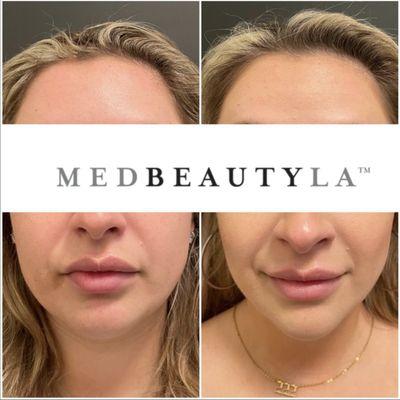 Facial contour and refinement with dermal filler.