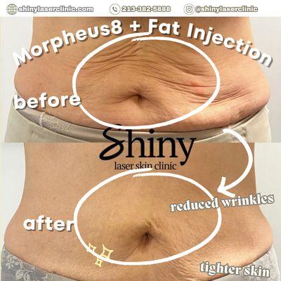 This patient wanted her sagging skin stomach tightened. Solution: 5 sessions of Morpheus8 and fat reduction injections.