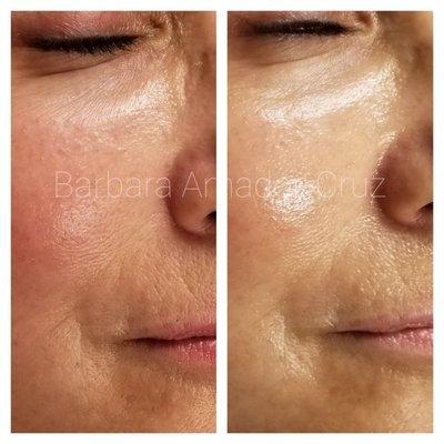 Custom facial focusing on firming and hydrating skin.