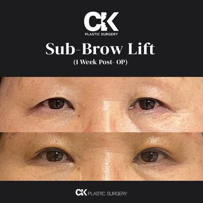 Sub-Brow Lift