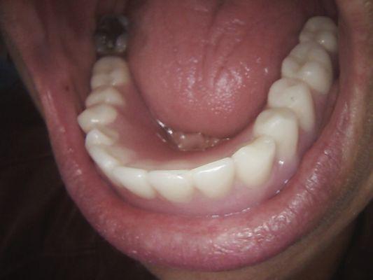 Denture over Implant