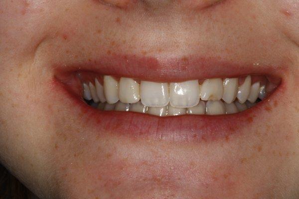 Chipped tooth before Veneer