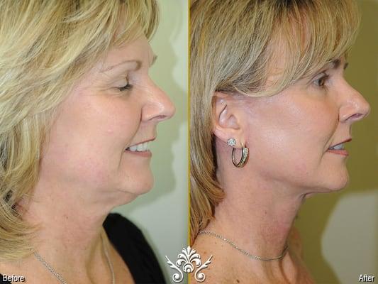 Face Lift by Tri Valley Plastic Surgery