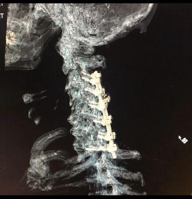 C3-T1 Fusion. Done 12/2017...  no issues since, Doctor L Zucker.