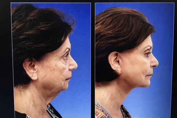 Before and after Steiger Deep Plane Facelift (including neck)