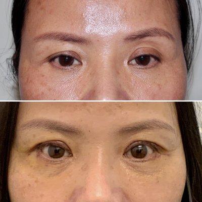 Anchoring Blepharoplasty with Ptosis Correction