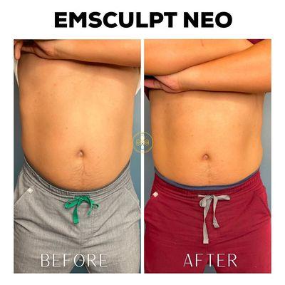 Before and After Emsculpt Neo Body Sculpting for Abdomen