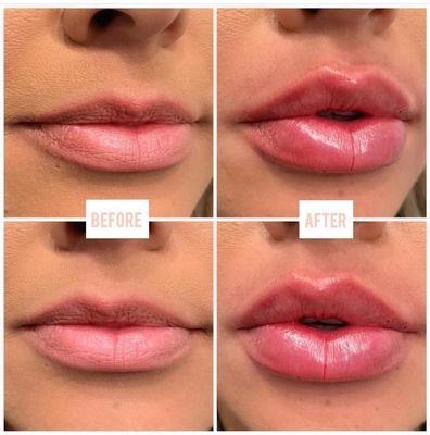 Lip Filler