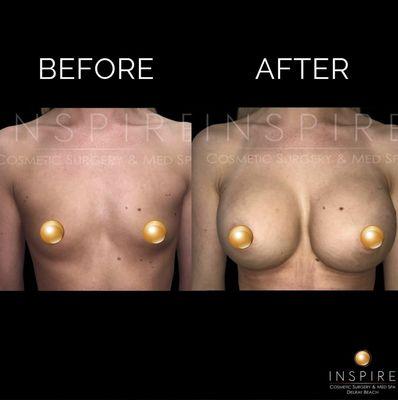 Before and after breast augmentation by one of Inspire Cosmetic Surgery & Med Spa's Board Certified Plastic Surgeons.