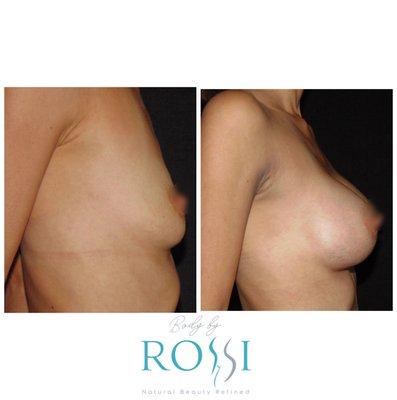 Gorgeous submuscular silicone Breast Augmentation on this petite mother of 3 during a Mommy Makeover Procedure.