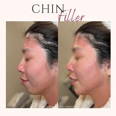 Chin filler