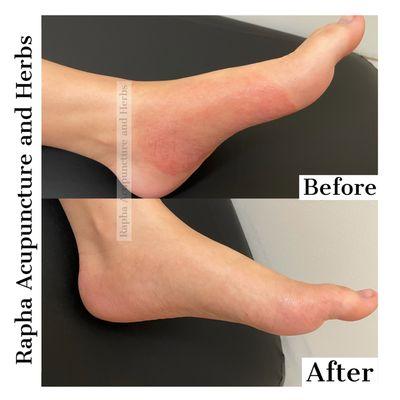 Eczema treatment on the foot